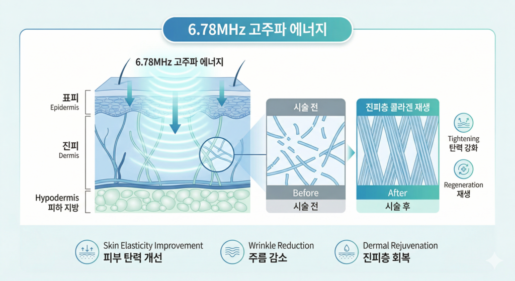구월동 볼뉴머 리프팅 단극성 고주파 진피층 전달 원리